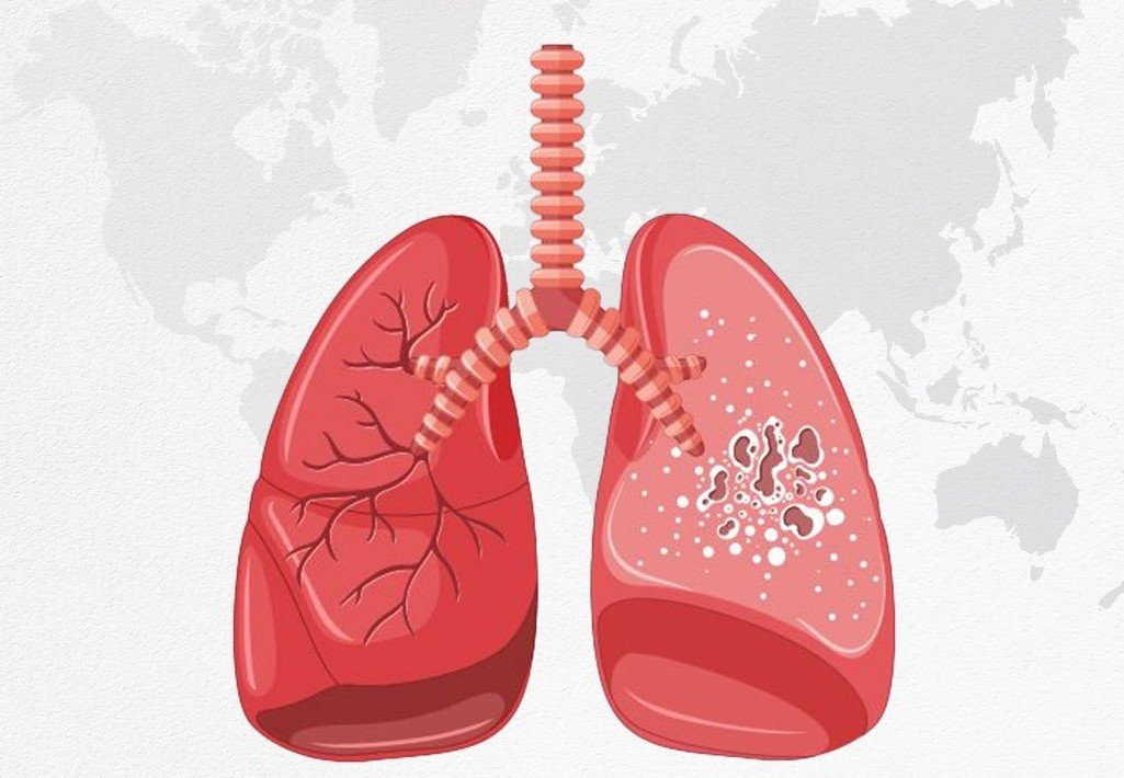 जागतिक क्षयरोग निवारण दिन